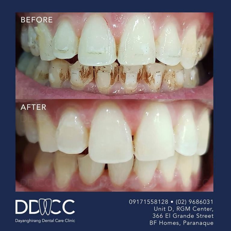 Dayanghirang Dental Care Clinic - Before and After 2 - DDCC