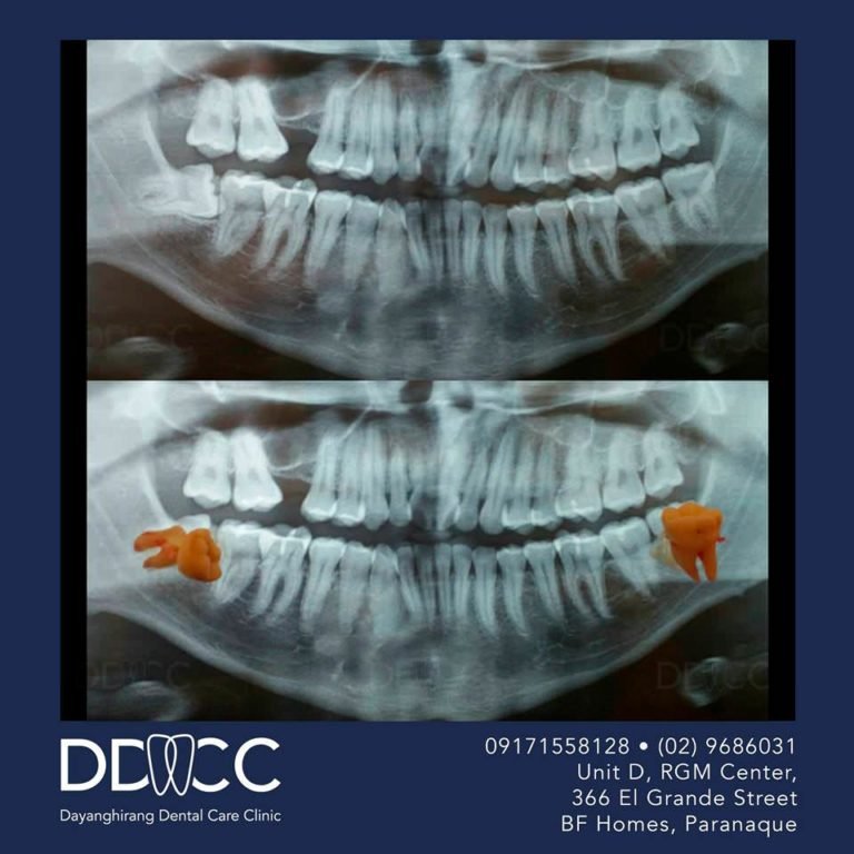 Dayanghirang Dental Care Clinic - Before and After 4 - DDCC